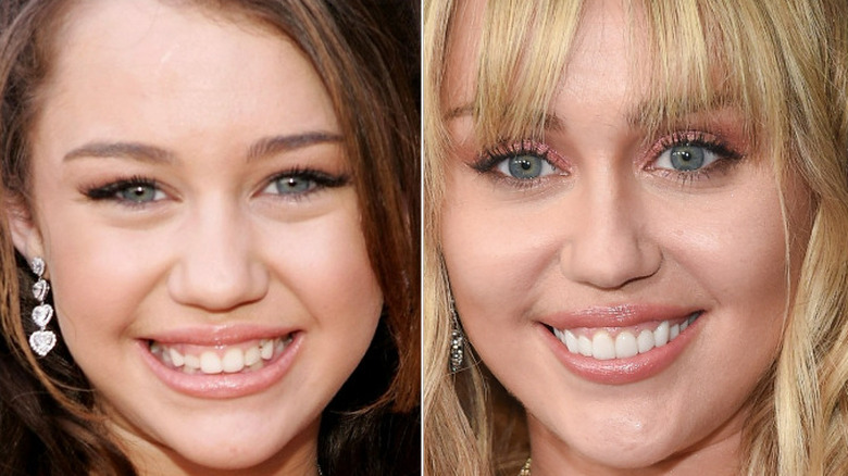 Miley Cyrus' smile before after