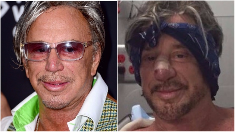 Mickey Rourke nose job before and after 