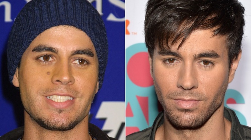 Enrique Iglesias with mole on face; Enrique Iglesias after surgery