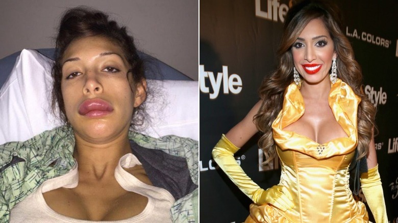 Farrah Abraham before and after surgery