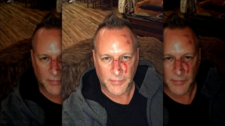 Dave Coulier with a bloody face