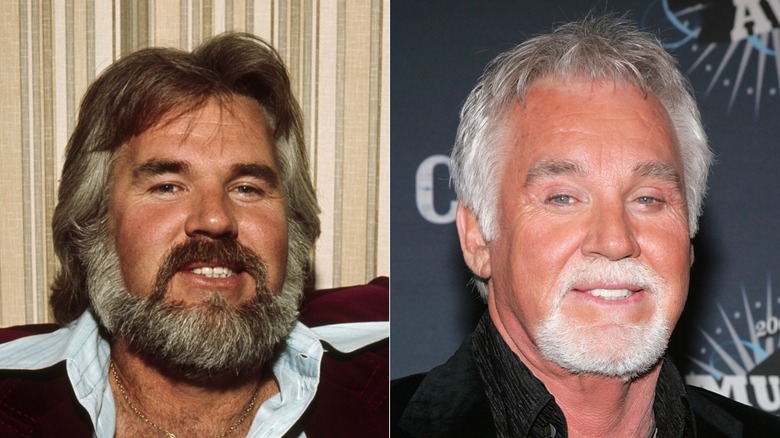 Kenny Rogers before and after cosmetic procedure