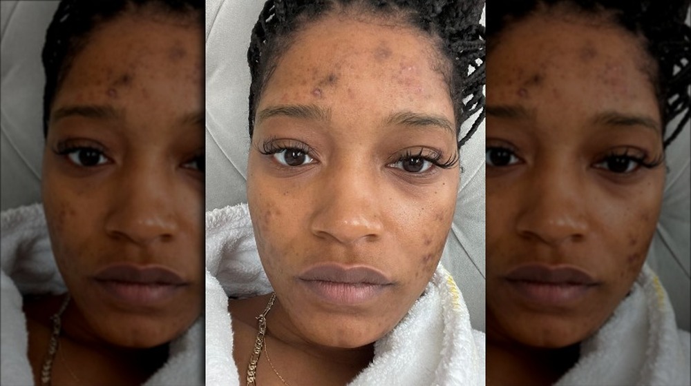 How Keke Palmer Found Out The Truth About Her Pcos