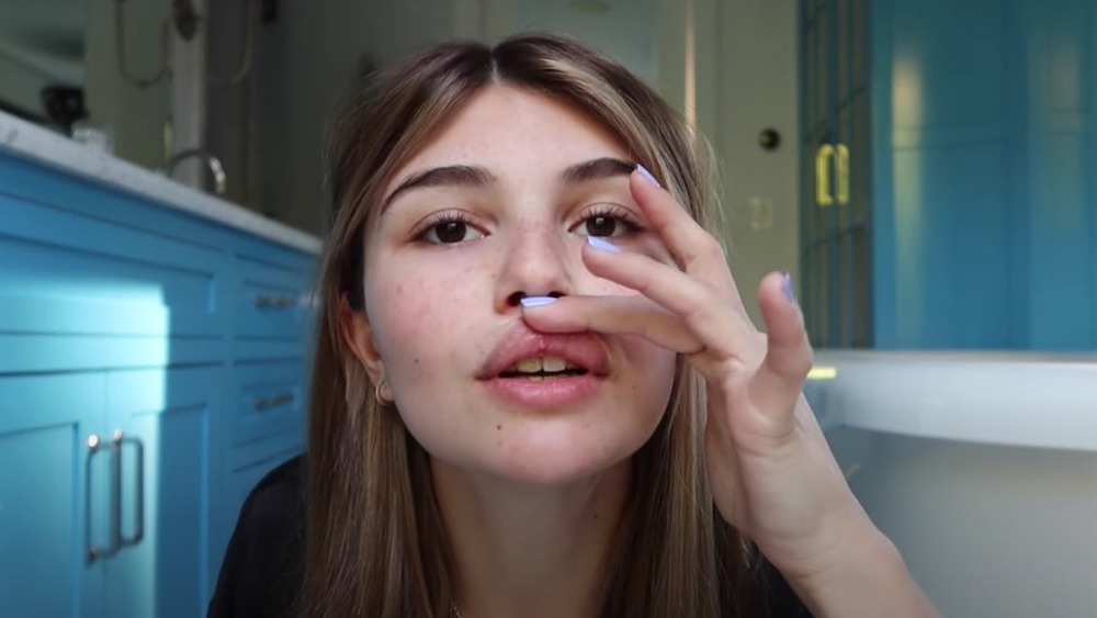 Olivia Jade showing her split lip