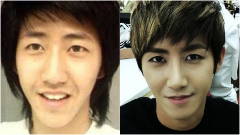 Kwanghee from ZE:A before-and-after plastic surgery photos