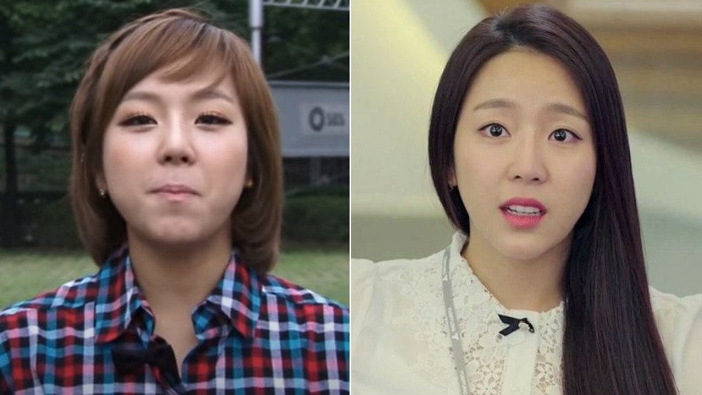 Yewon before-and-after plastic surgery photos