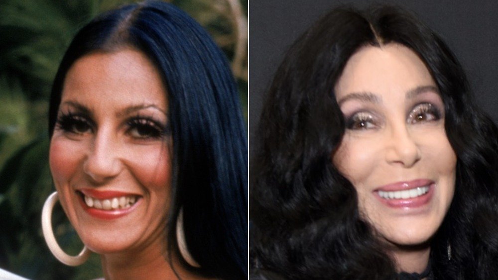 Cher before and after photos showing off her teeth