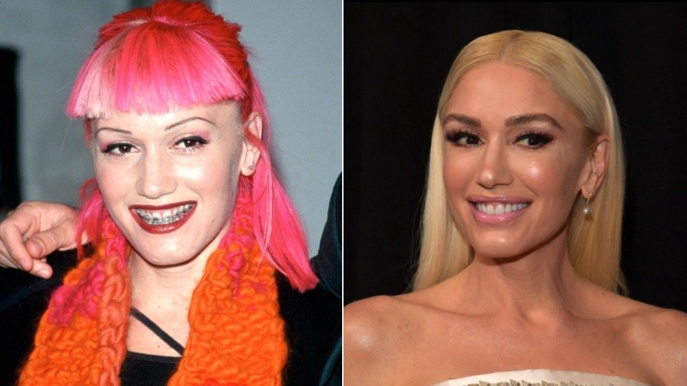 Gwen Stefani before and after photos showing off her teeth