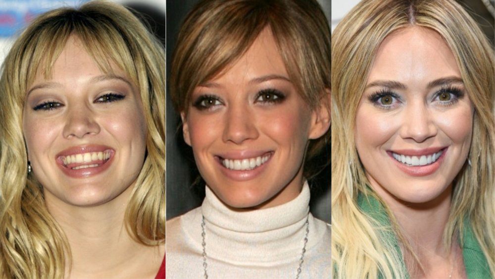 Hilary Duff before and after photos showing off her teeth