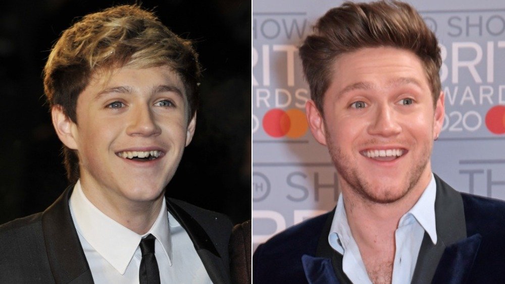 Niall Horan before and after photos showing off his teeth