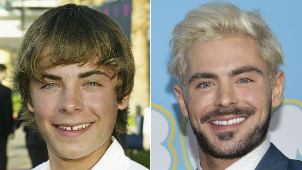 Zac Efron before and after photos showing off his teeth