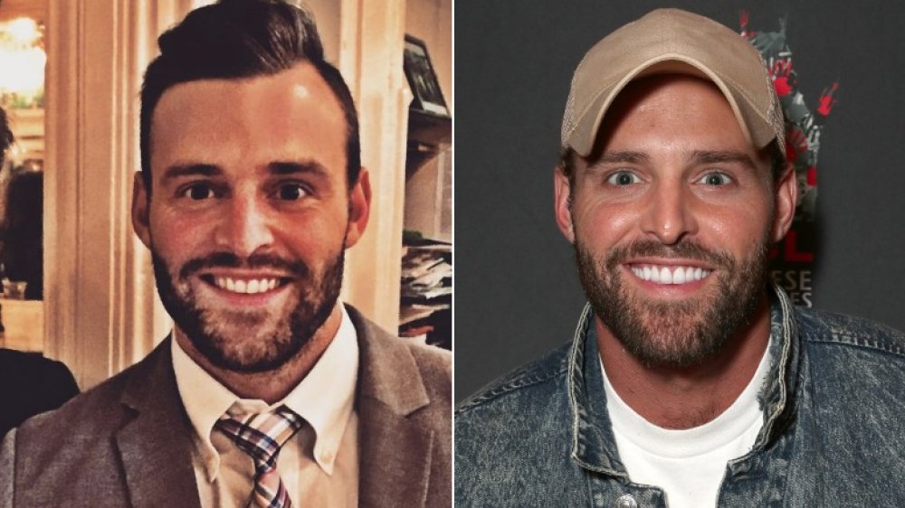 Robby Hayes veneers before and after