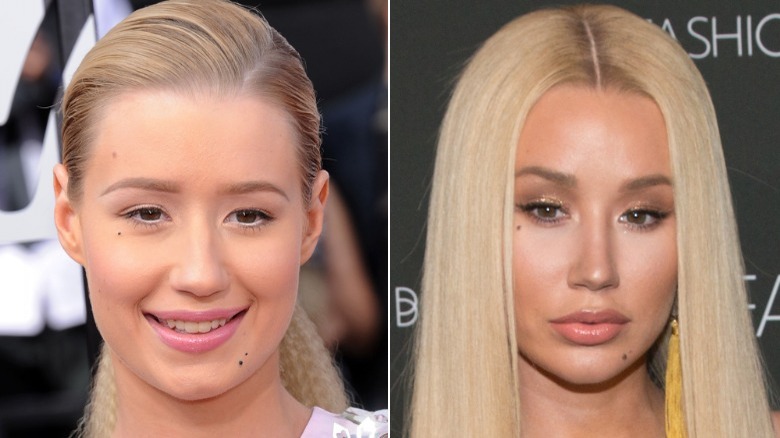 Side-by-side pictures of Iggy Azalea smiling before and after her nose job