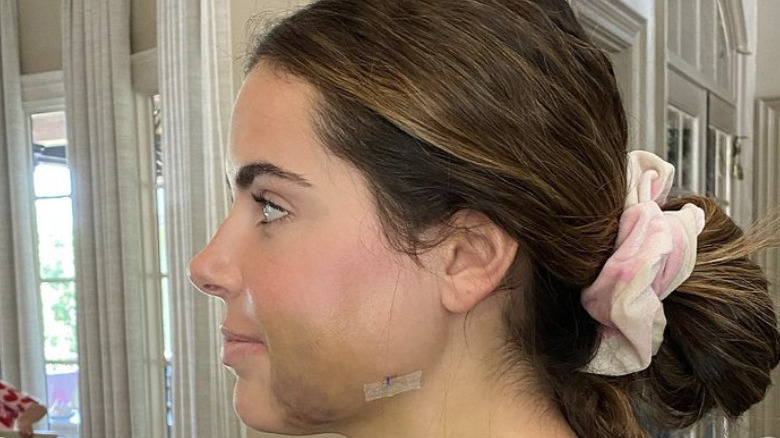 Brielle Biermann jaw surgery