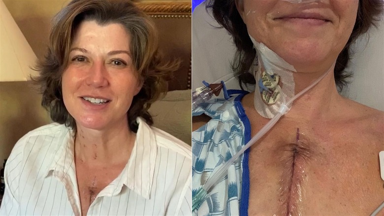 Amy Grant showing heart surgery scar