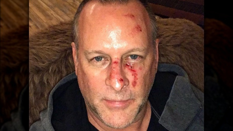 Dave Coulier poses for with a bloodied face