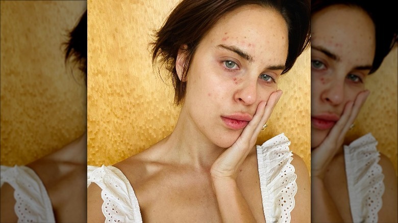 Tallulah Willis shows skin lesions