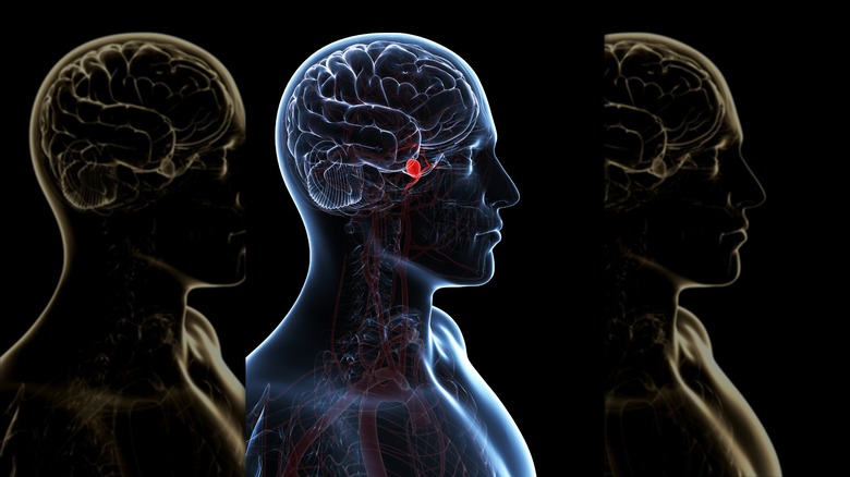 Illustration of blood clot in brain