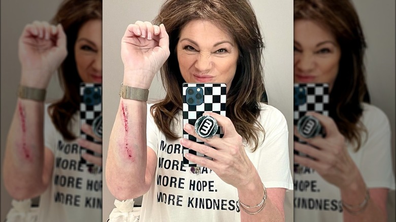 Valerie Bertinelli poses for a selfie with her injured arm.