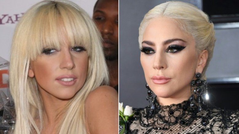 Lady Gaga before and after alleged fillers