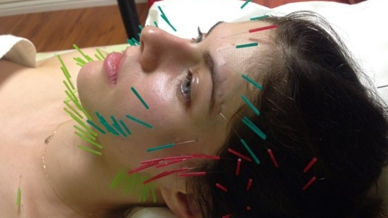 Alexandra Daddario acupuncture needles face